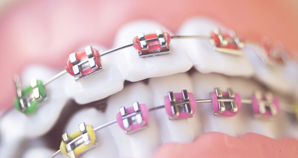 Aparat ortodontyczny a choroby jamy ustnej
