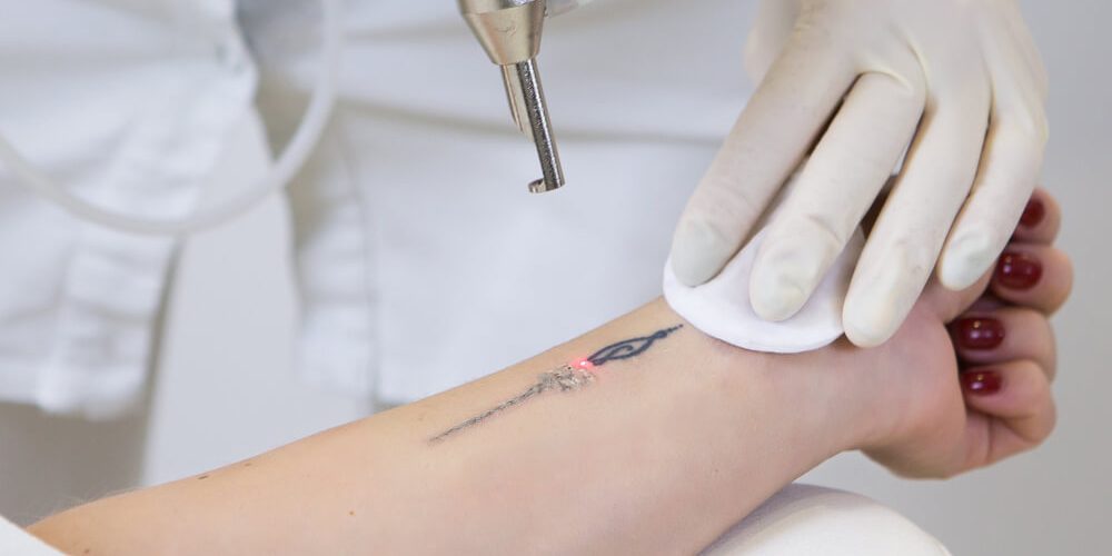 Laserowe usuwanie tatuażu oraz makijażu permanentnego – przebieg zabiegu i jego efekty